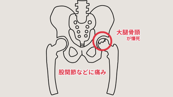 特発性大腿骨頭壊死症